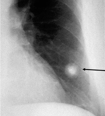 What will CXR classically reveal in a pt. with lung cancer?