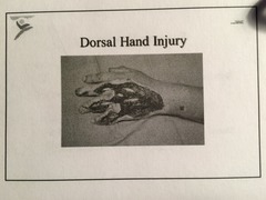 What's a good way of reconstructing this dorsal hand injury?