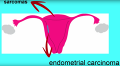 What's the difference between Endometrial Carcinoma and Sarcoma of Uterus?