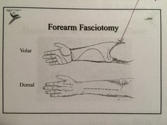 When doing a fasciotomy - what are you releasing and what do you do down the line?