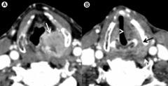 Where do cancers of lateral pyriform sinus extend to