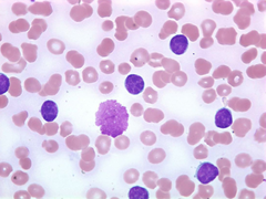 Which of the following is a true statement about leukemia?