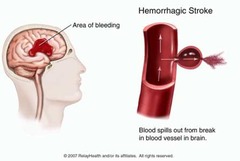 Which of the following types of stroke has symptoms that are similar to those of an ischemic stroke, and in addition, also has sudden severe headache, nausea, and vomiting?