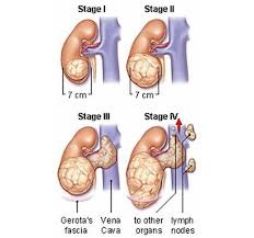 Wilms' Tumor  Staging