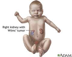 Wilms' Tumor Clinical Symptoms Diagnostic Tests