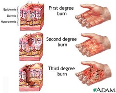 first-degree burn