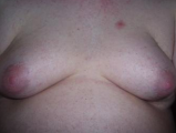 gynaecomastia