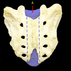 sacral canal