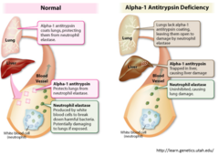 Mutations in α-antitrypsin (AAT) deficiency are a result of what?